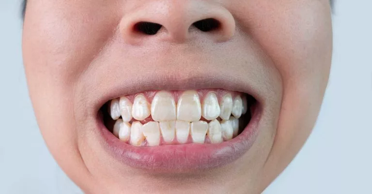 person showing their teeth that has various white spots on their teeth