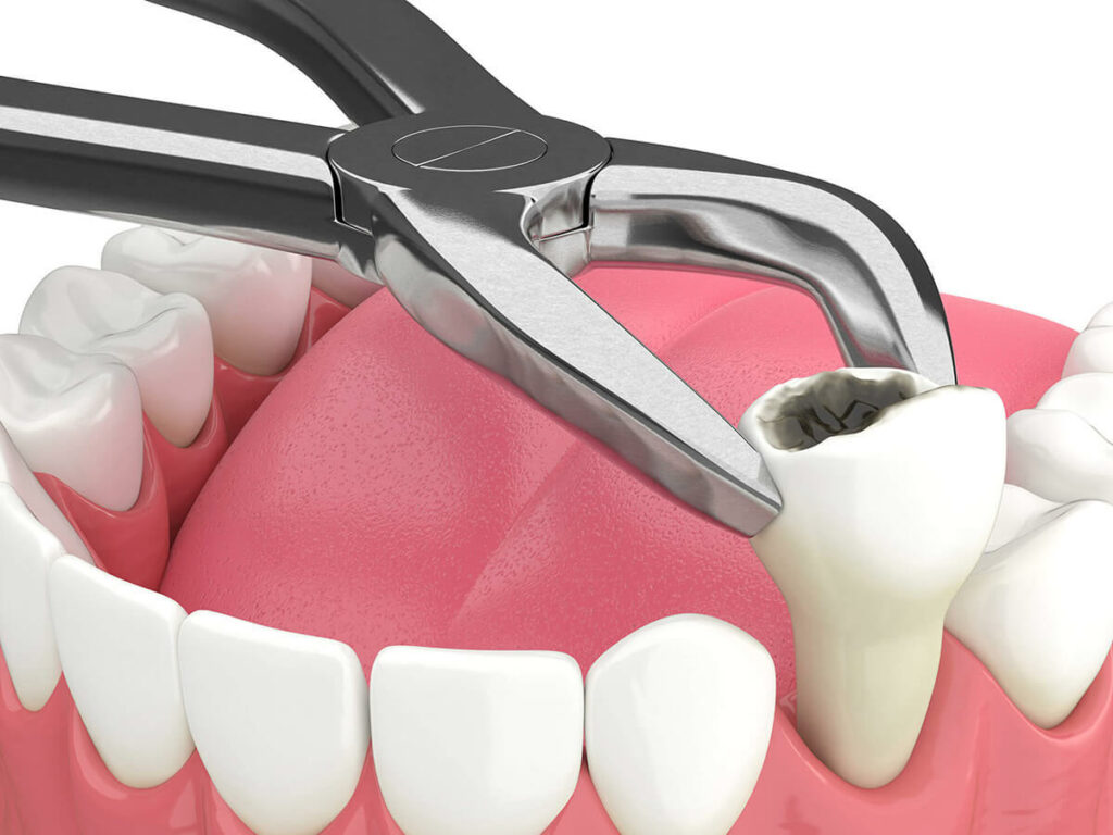 Tooth Extraction Understanding the Procedure and Aftercare