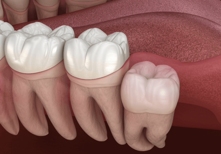 A 3D rendering of a section of a mouth, showcasing the molars and an impacted wisdom tooth. The first three teeth on the left are healthy molars, while the fourth tooth on the right is the impacted wisdom tooth, growing at an angle and pressing against the adjacent molar.